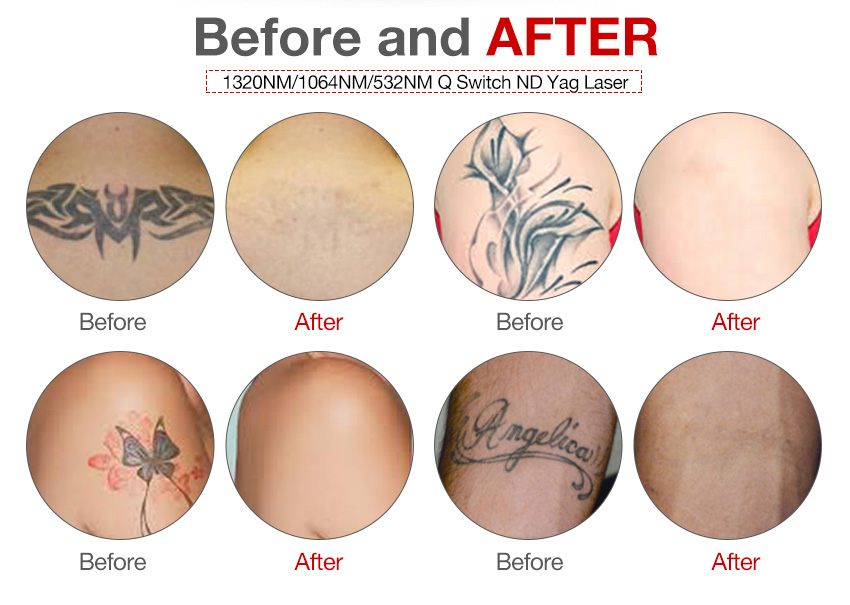 Tattoo removal 2020 ND yag laser machine CE certification